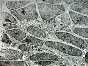 M,4y. | medulloblastoma M,4y. | medulloblastoma